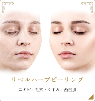 リベルハーブピーリング